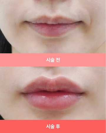 비포애프터 1 모바일