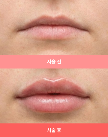 비포애프터 2 모바일