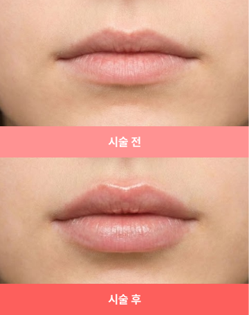 비포애프터 3 모바일